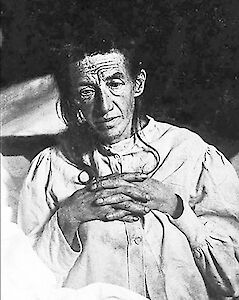 Auguste Deter, die erste Alzheimerpatientin der Welt.