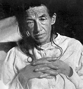 Auguste Deter war die erste Alzheimer-Patientin.